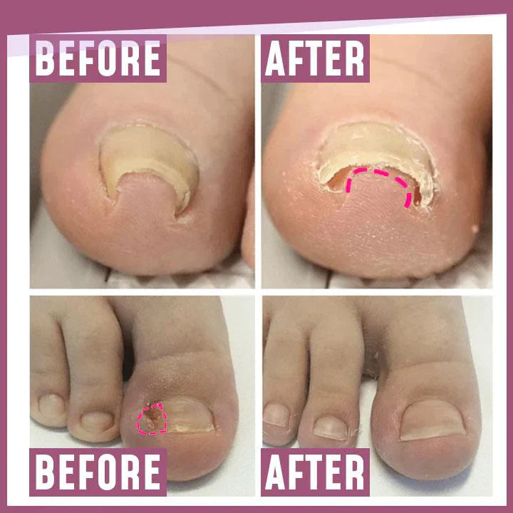 Lighteme Toenail Corrector Patches