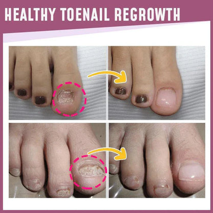 Lighteme Toenail Corrector Patches