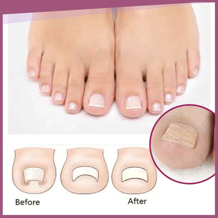 Lighteme Toenail Corrector Patches