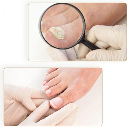 Lighteme Nail Plaster & Nail Patches - Painless nail care